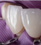 ציפוי שיניים: טיפול מוביל ברפואת שיניים מתקדמת-תמונה